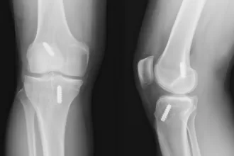 X-ray images of a knee joint, highlighting ACL and PCL reconstruction details for medical analysis.