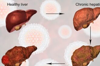 Cause of liver cirrhosis illustration
