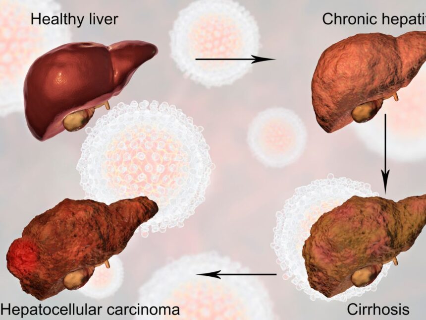 Cause of liver cirrhosis illustration