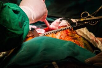 Coronary Artery Bypass ICD-10