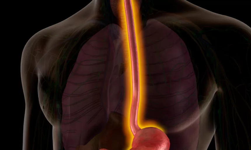 Illustration of the stomach and small intestine, highlighting the surgical repair of esophageal atresia and tracheoesophageal fistula.