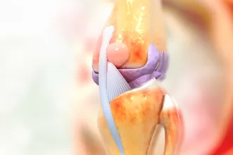 Close-up view of a knee joint, highlighting details relevant to joint replacement revisions and surgical procedures.