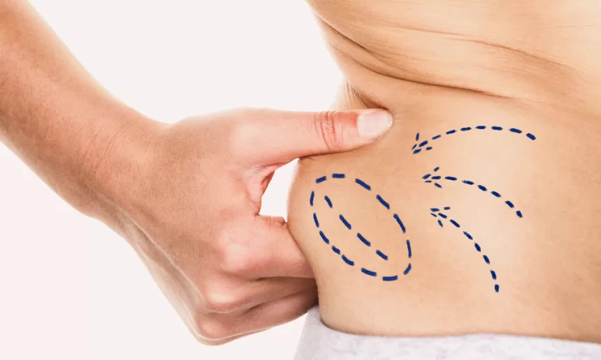 A person holds a blue arrow on their stomach, symbolizing the results of liposuction and body contouring.
