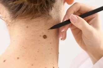 A woman with a black pen resting on her neck, showcasing a recent mole removal procedure.