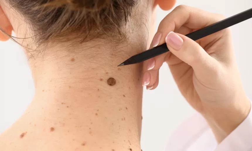 A woman with a black pen resting on her neck, showcasing a recent mole removal procedure.