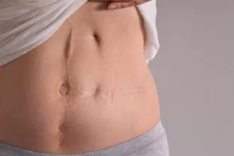 A woman displaying her stomach scar, showcasing the results of recent scar revision surgery.