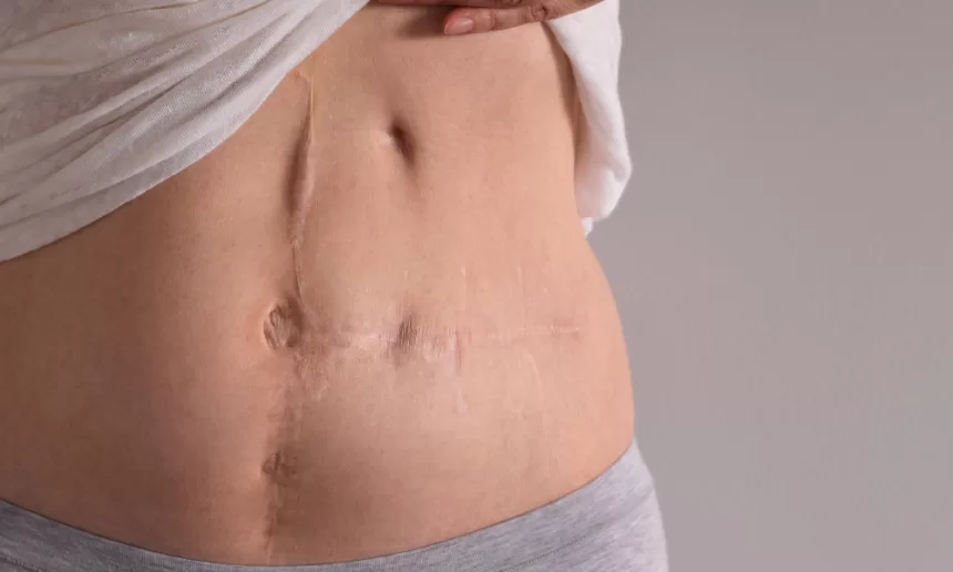 A woman displaying her stomach scar, showcasing the results of recent scar revision surgery.