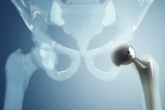 3D image of a hip joint, illustrating the anatomy involved in total hip replacement surgery.