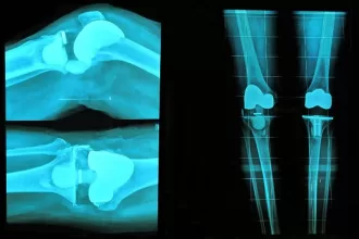 pain after total knee replacement