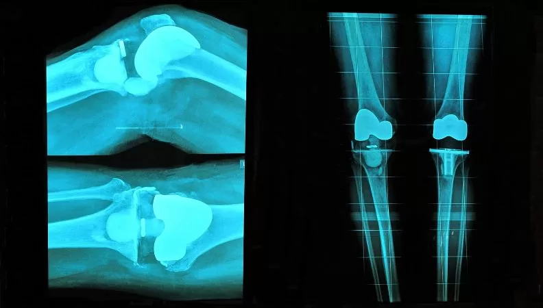 pain after total knee replacement